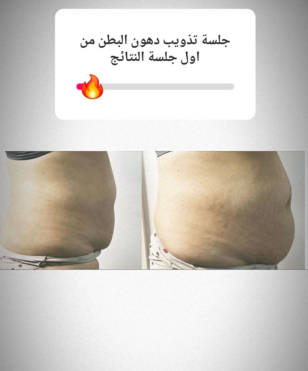 Belly Fat Dissolving Result