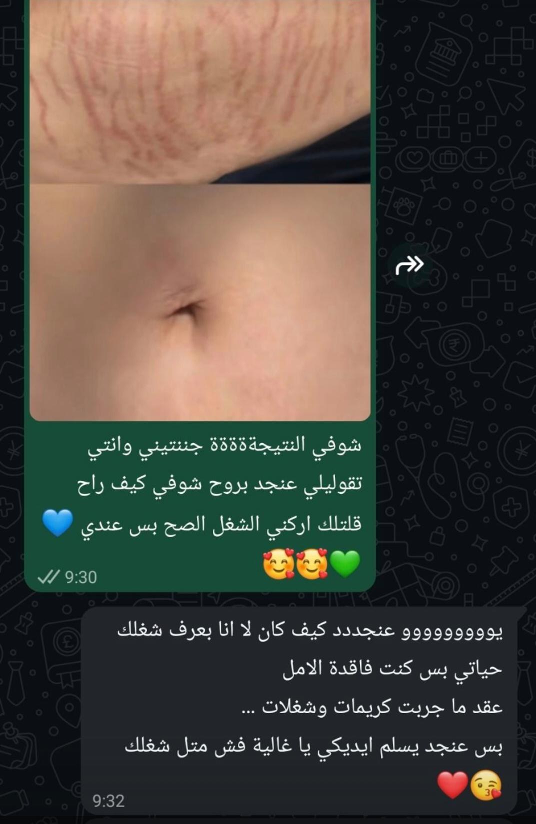 Customer Testimonial — Stretch Marks