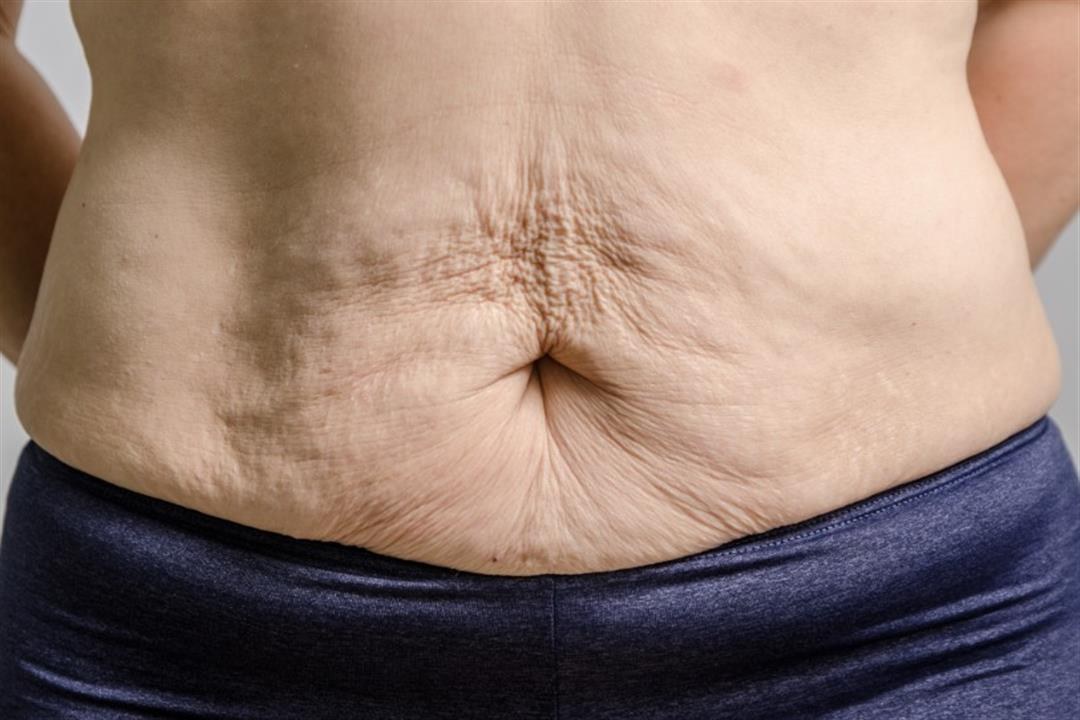 Abdominal Skin Tightening