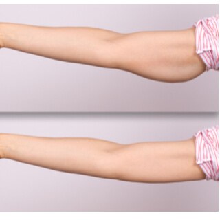 Arm Tightening and Fat Reduction