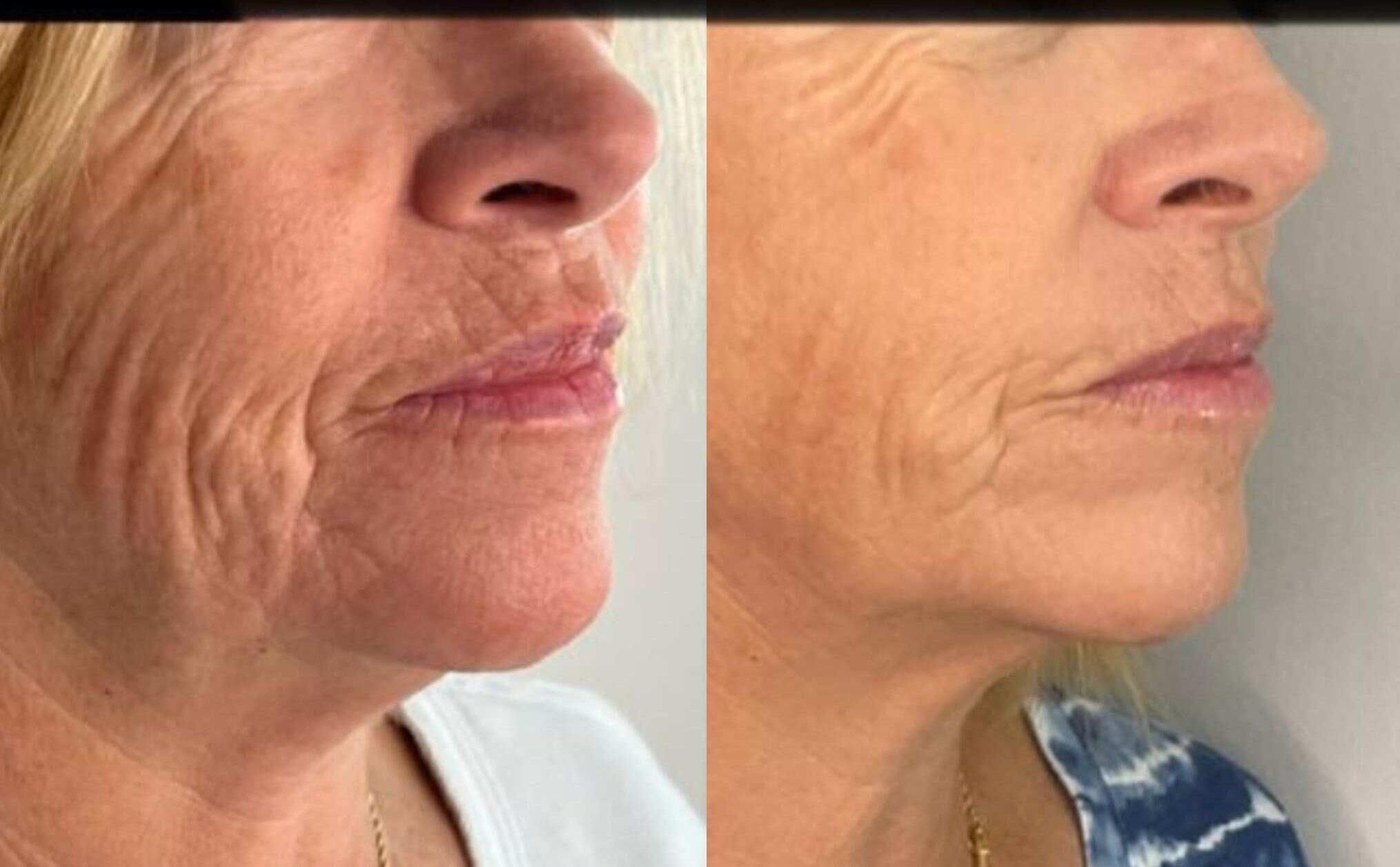 Skin Sagging Treatment