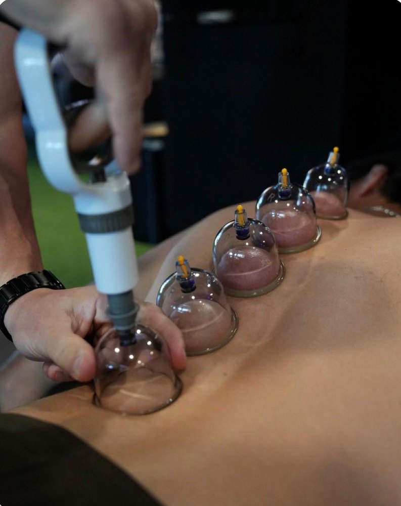 Therapeutic Cupping